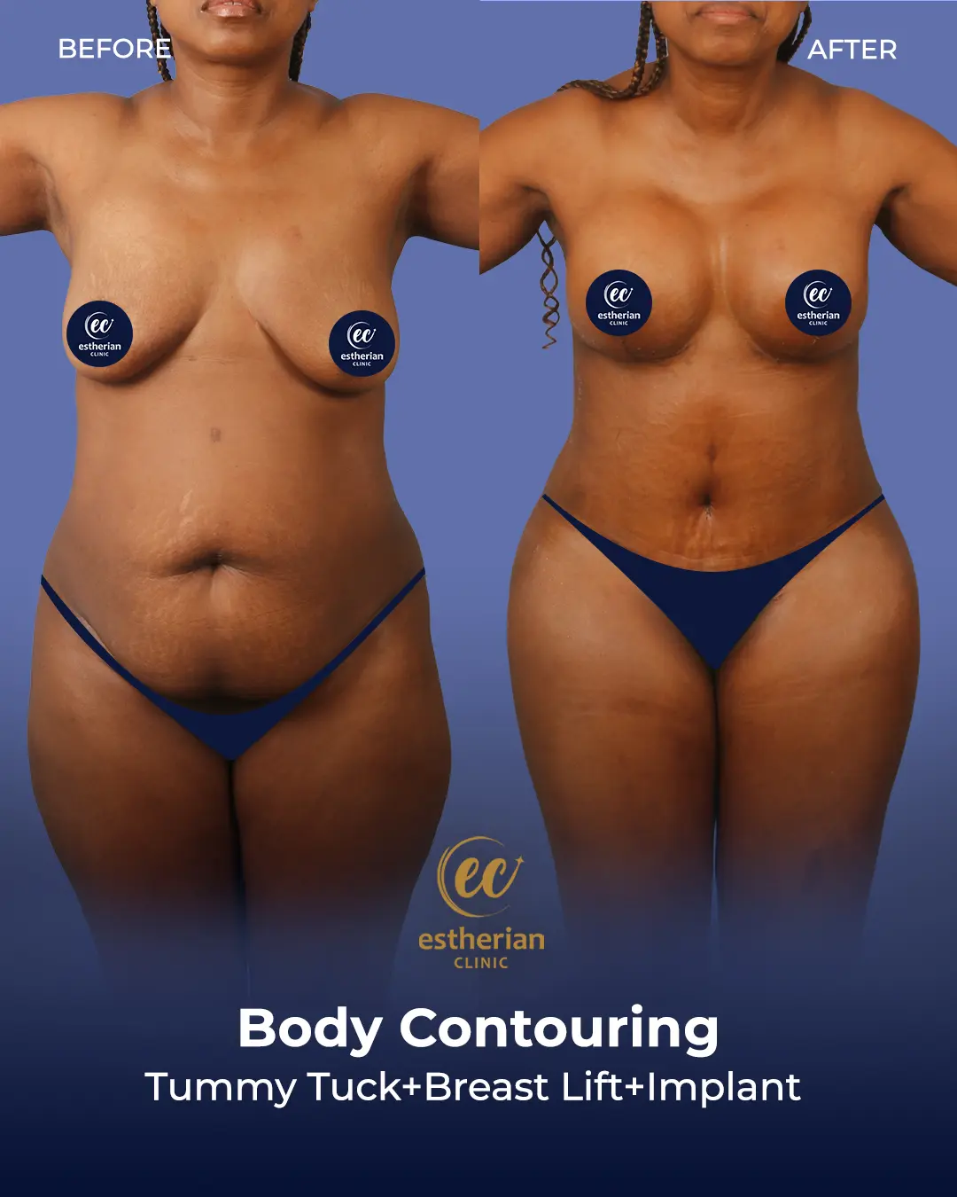 Body Contouring Surgery (before and after) by the Estherian Clinic