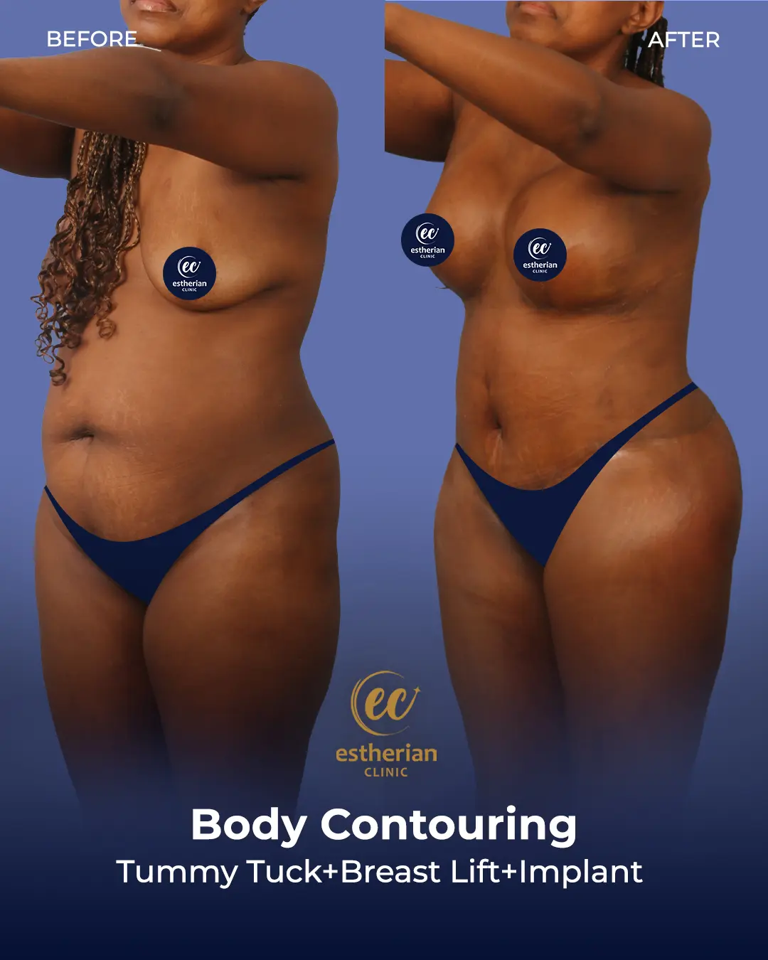 Body Contouring Surgery (before and after) by the Estherian Clinic