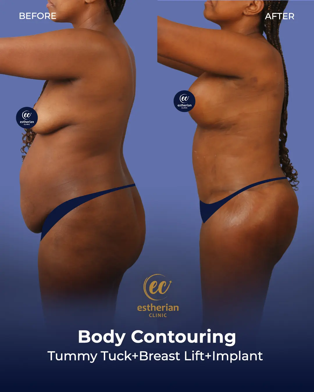 Body Contouring Surgery (before and after) by the Estherian Clinic
