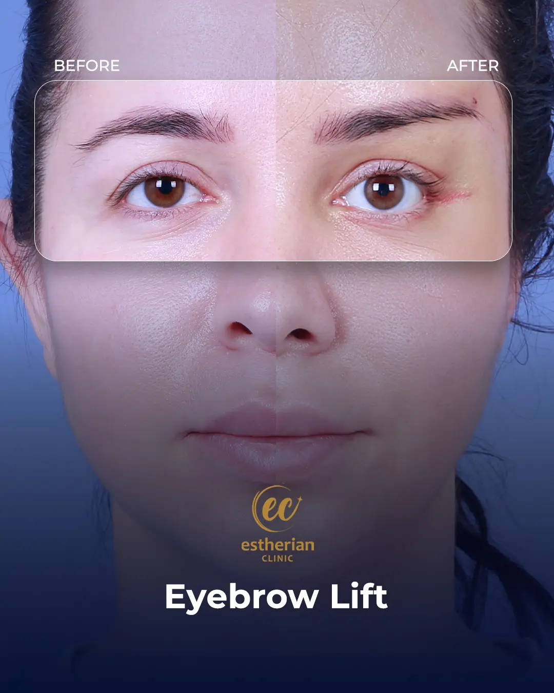 Browlift