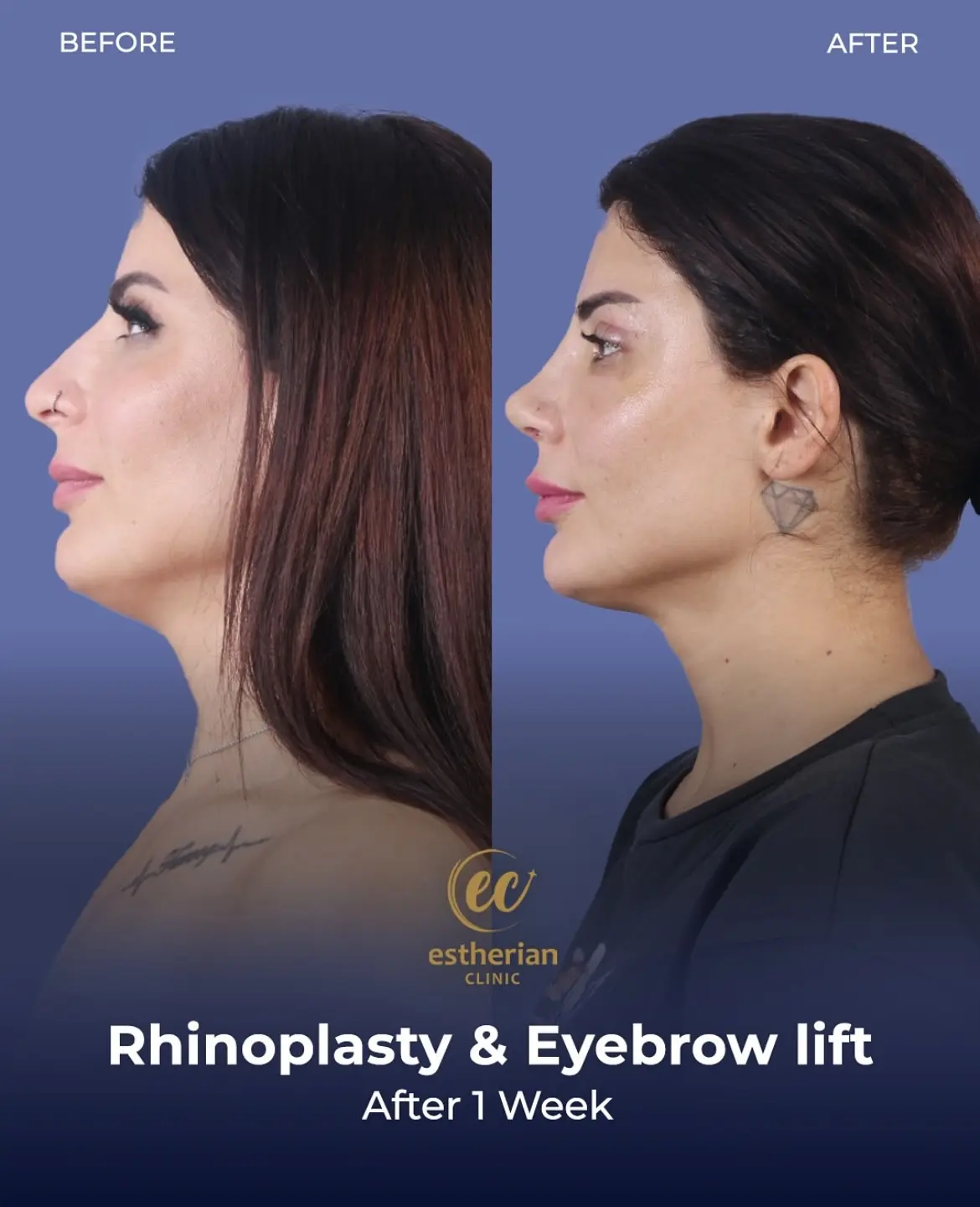 Ehinoplasty and Browlift
