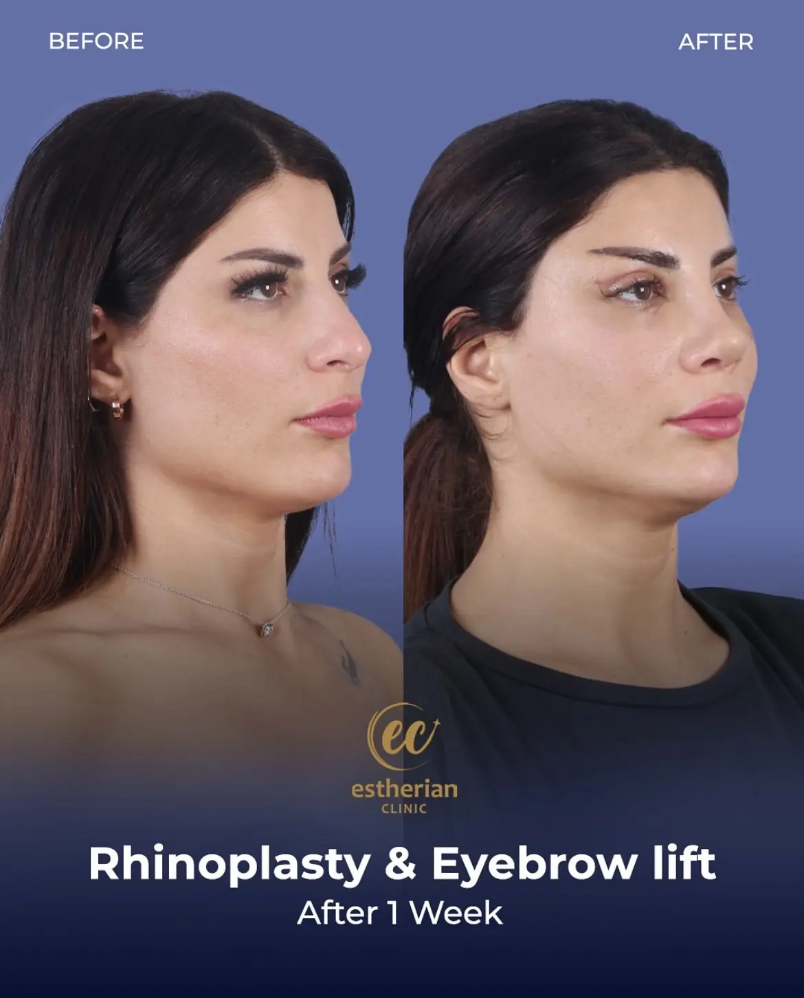 Ehinoplasty and Browlift