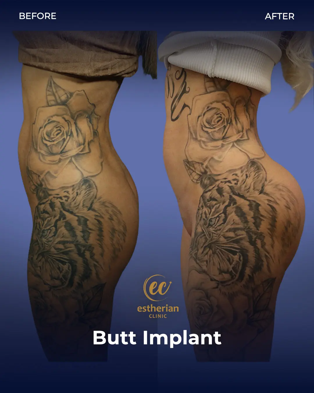 Butt Implant Before-and-after Patient Transformation by the Estherian Clinic