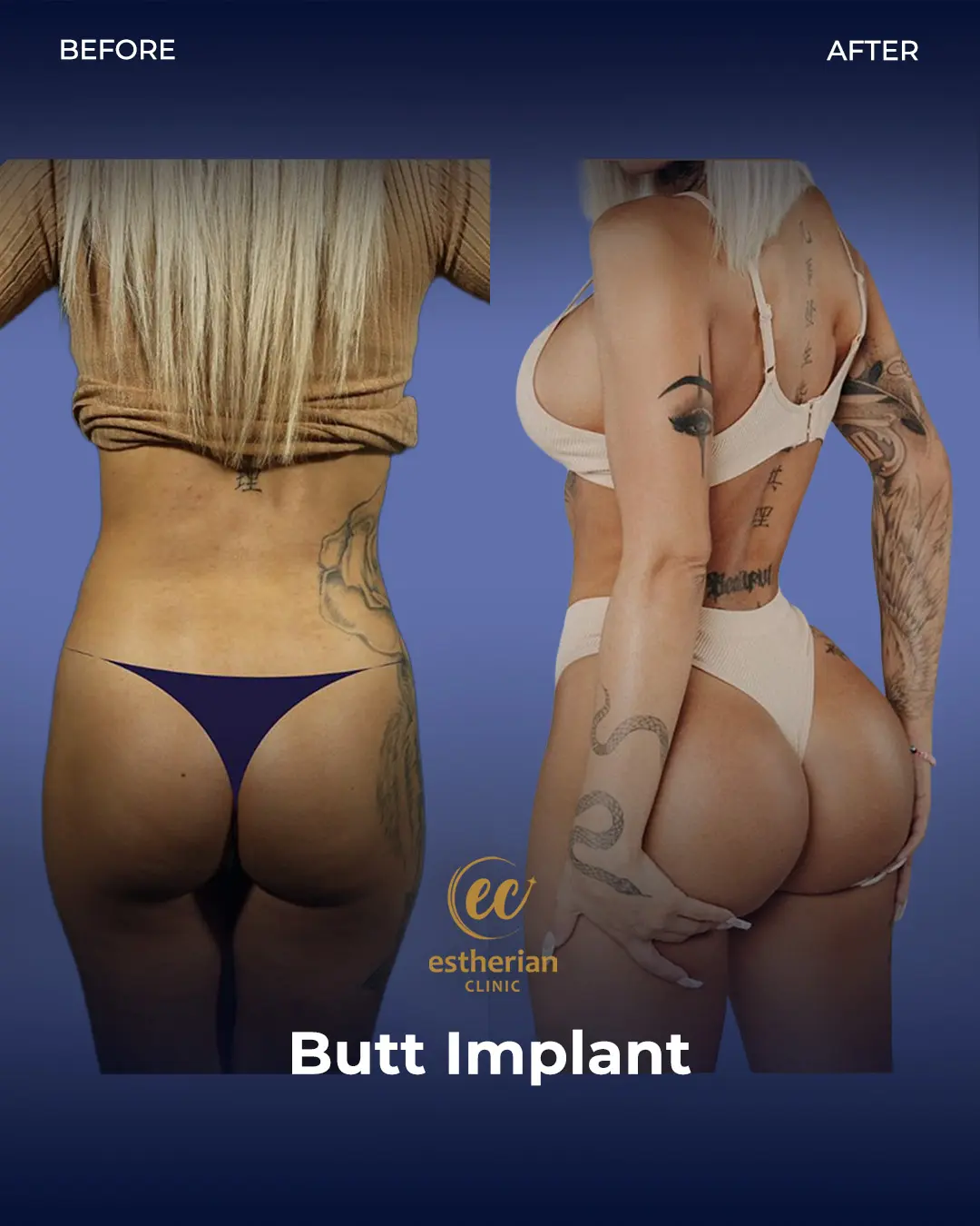 Butt Implant Before-and-after Patient Transformation by the Estherian Clinic
