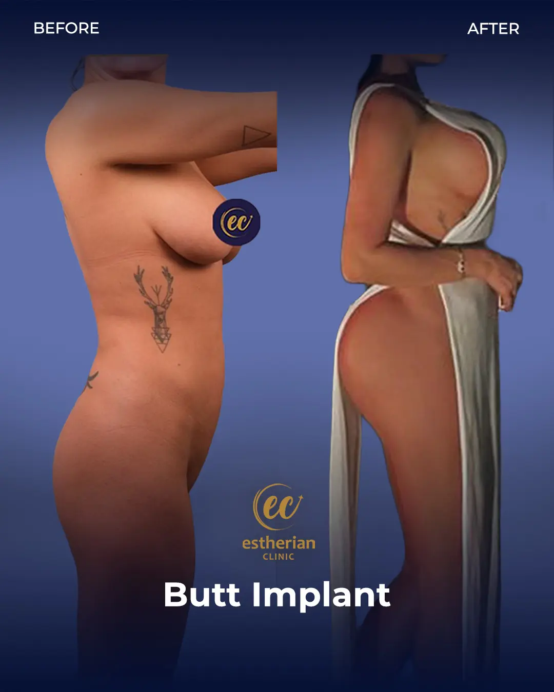 Butt Implant Before-and-after Patient Transformation by the Estherian Clinic