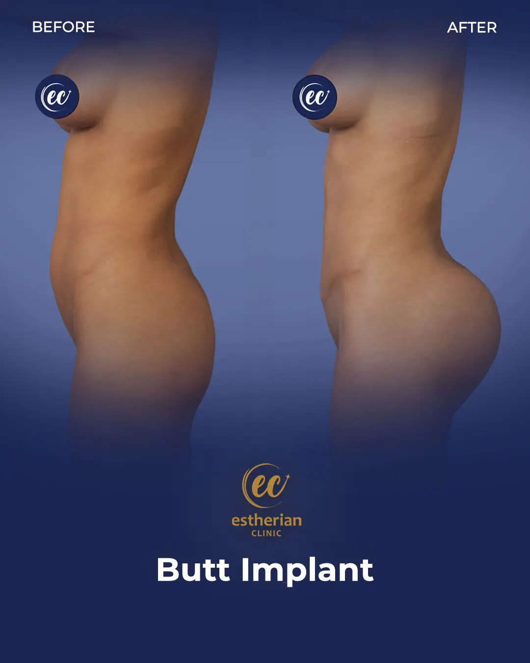 Butt Implant Before-and-after Patient Transformation by the Estherian Clinic