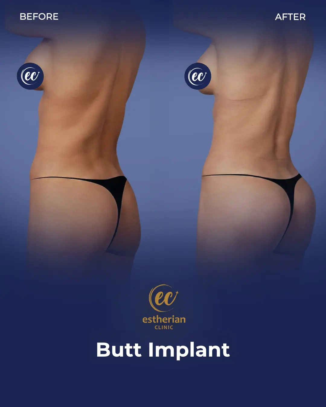 Butt Implant Before-and-after Patient Transformation by the Estherian Clinic