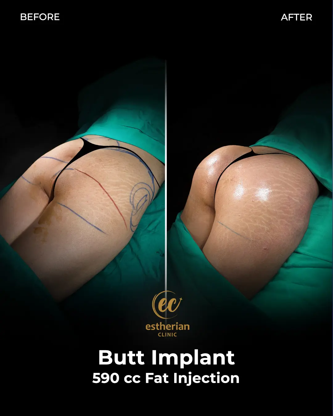 Butt Implant Before-and-after Patient Transformation by the Estherian Clinic