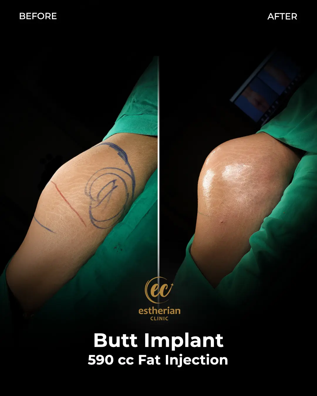 Butt Implant Before-and-after Patient Transformation by the Estherian Clinic
