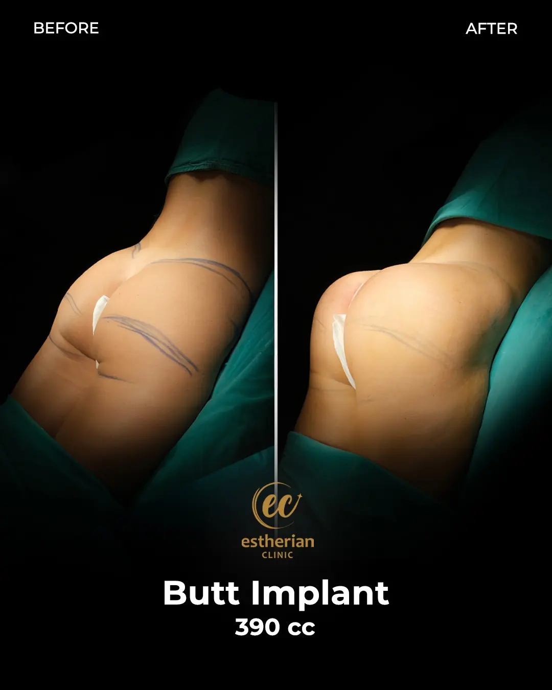 Butt Implant Before-and-after Patient Transformation by the Estherian Clinic