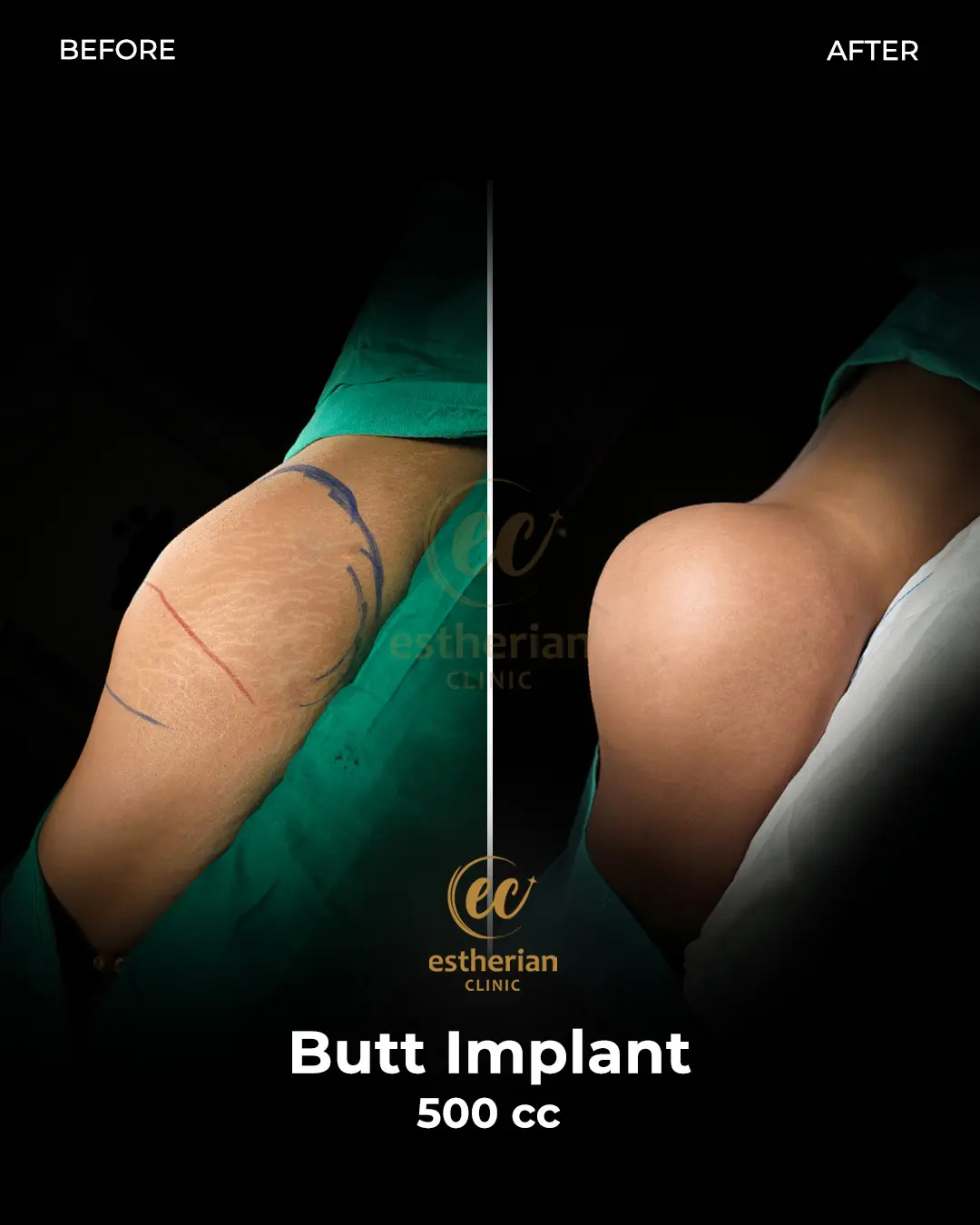 Butt Implant Before-and-after Patient Transformation by the Estherian Clinic