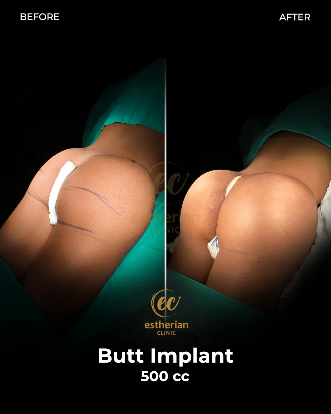 Butt Implant Before-and-after Patient Transformation by the Estherian Clinic