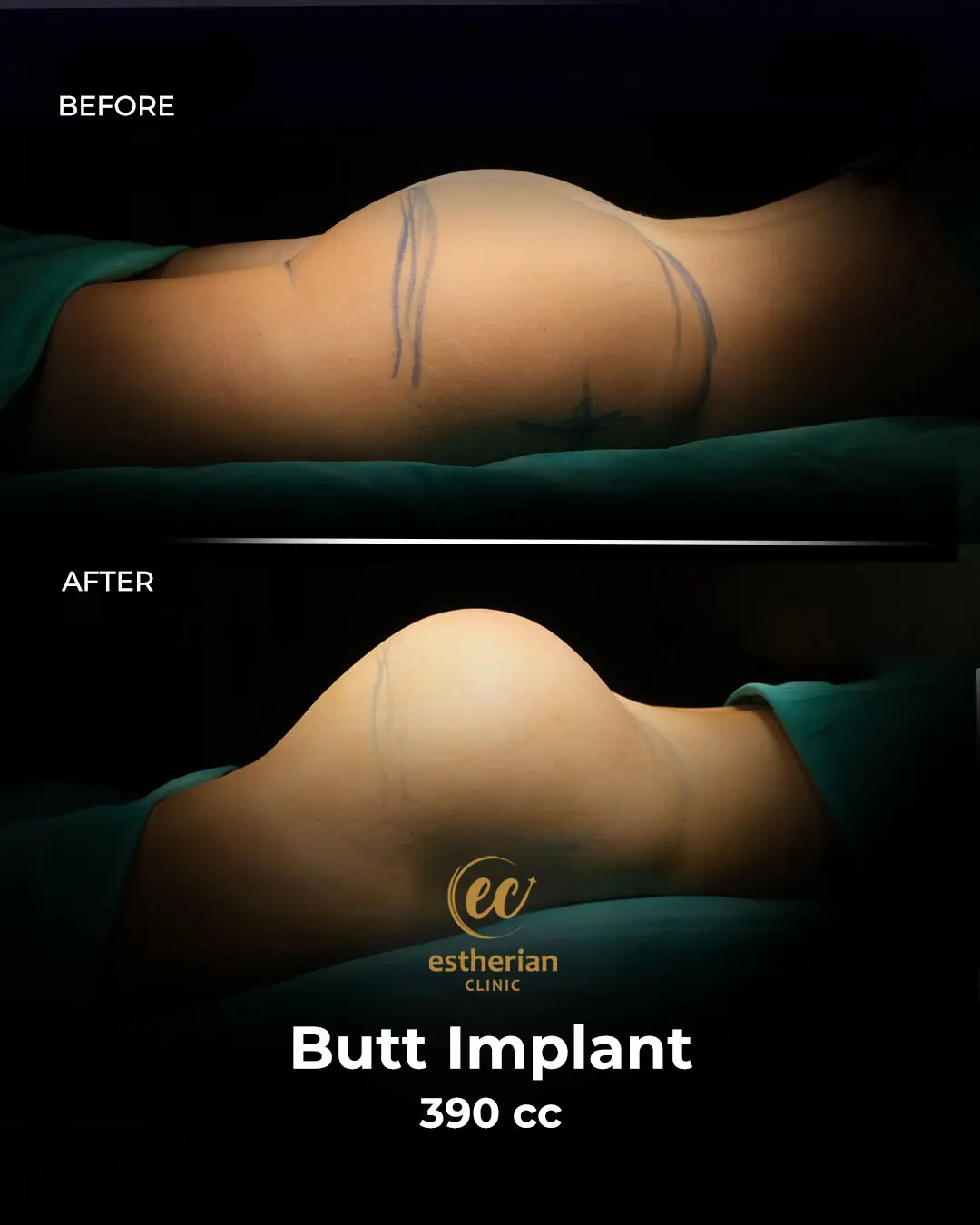 Butt Implant Before-and-after Patient Transformation by the Estherian Clinic
