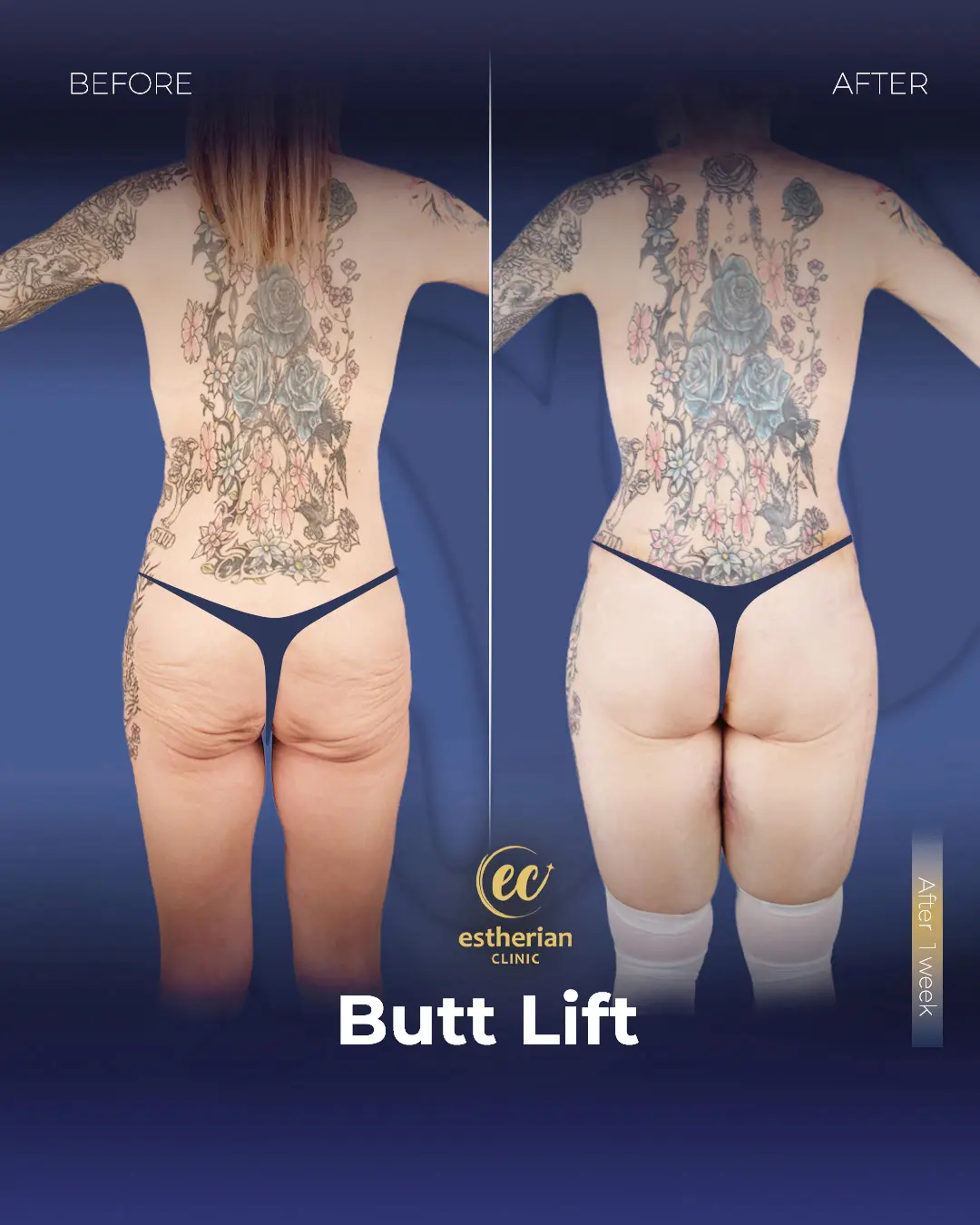 BBL - Brazilian Butt Lift Results by the Estherian Clinic