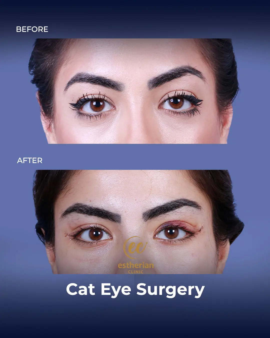 Cat Eye Surgery Results by the Estherian Clinic