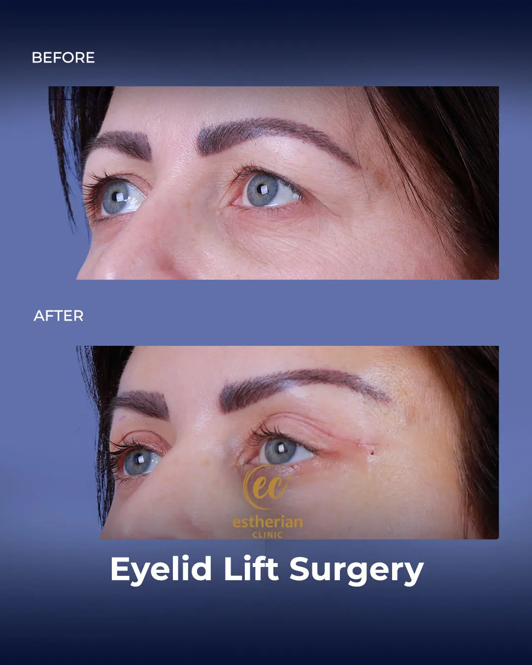 Eyelid Lift Surgery Results by the Estherian Clinic