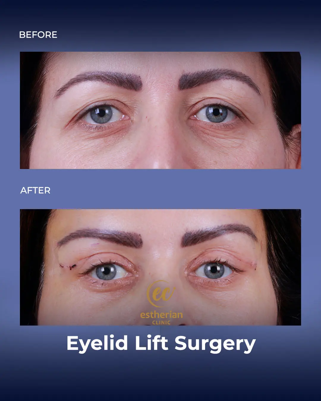 Eyelid Lift Surgery Results by the Estherian Clinic