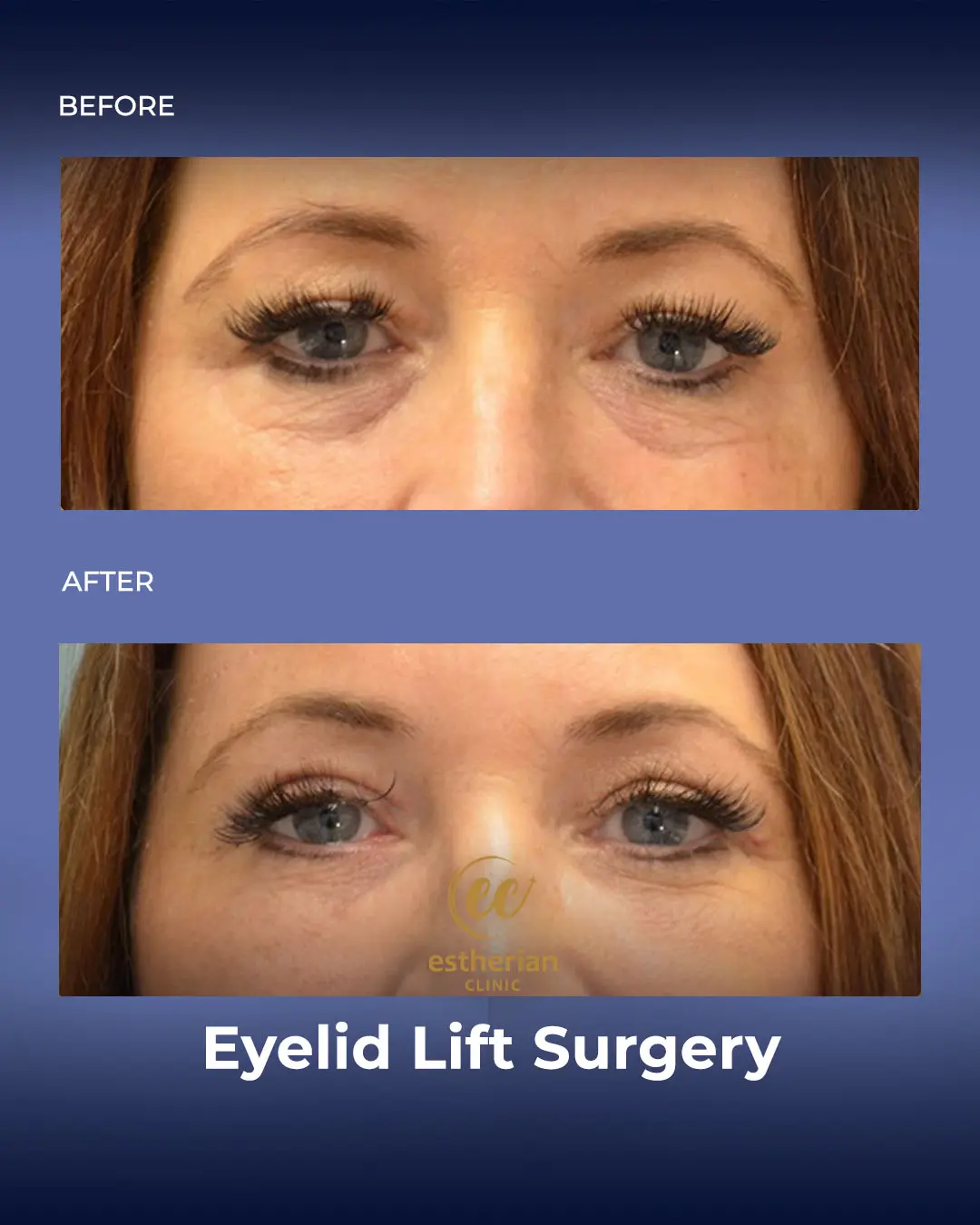 Eyelid Lift Surgery Results by the Estherian Clinic