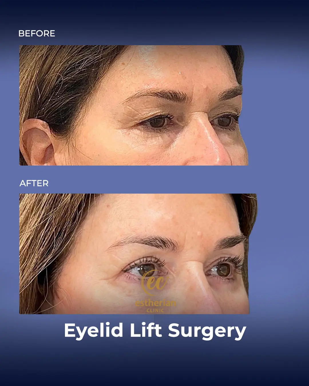 Eyelid Lift Surgery Results by the Estherian Clinic