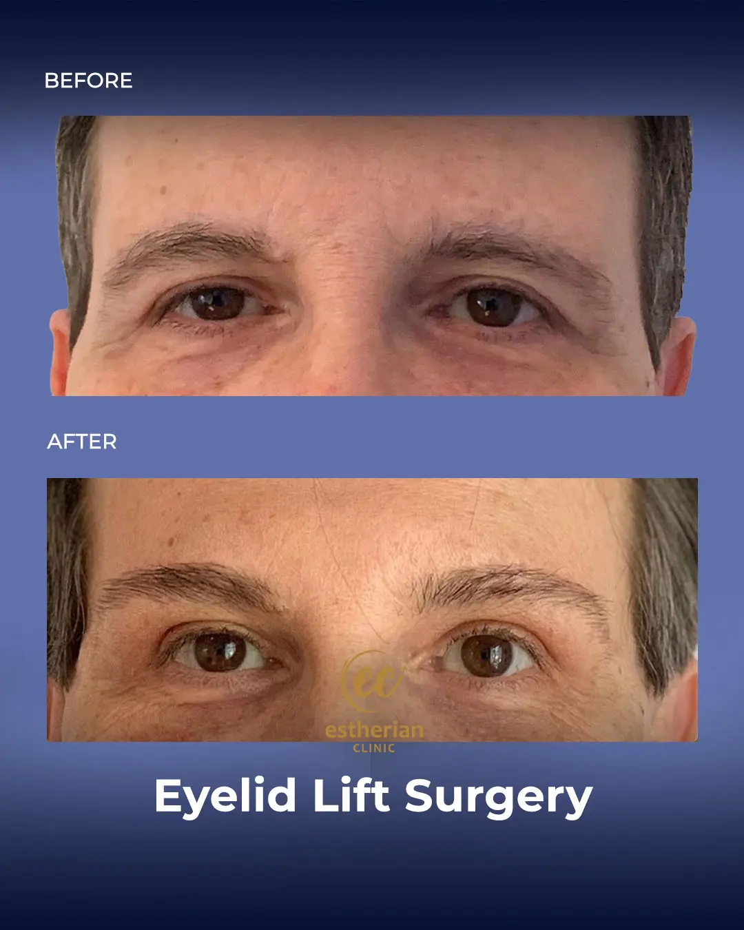 Eyelid Lift Surgery Results by the Estherian Clinic