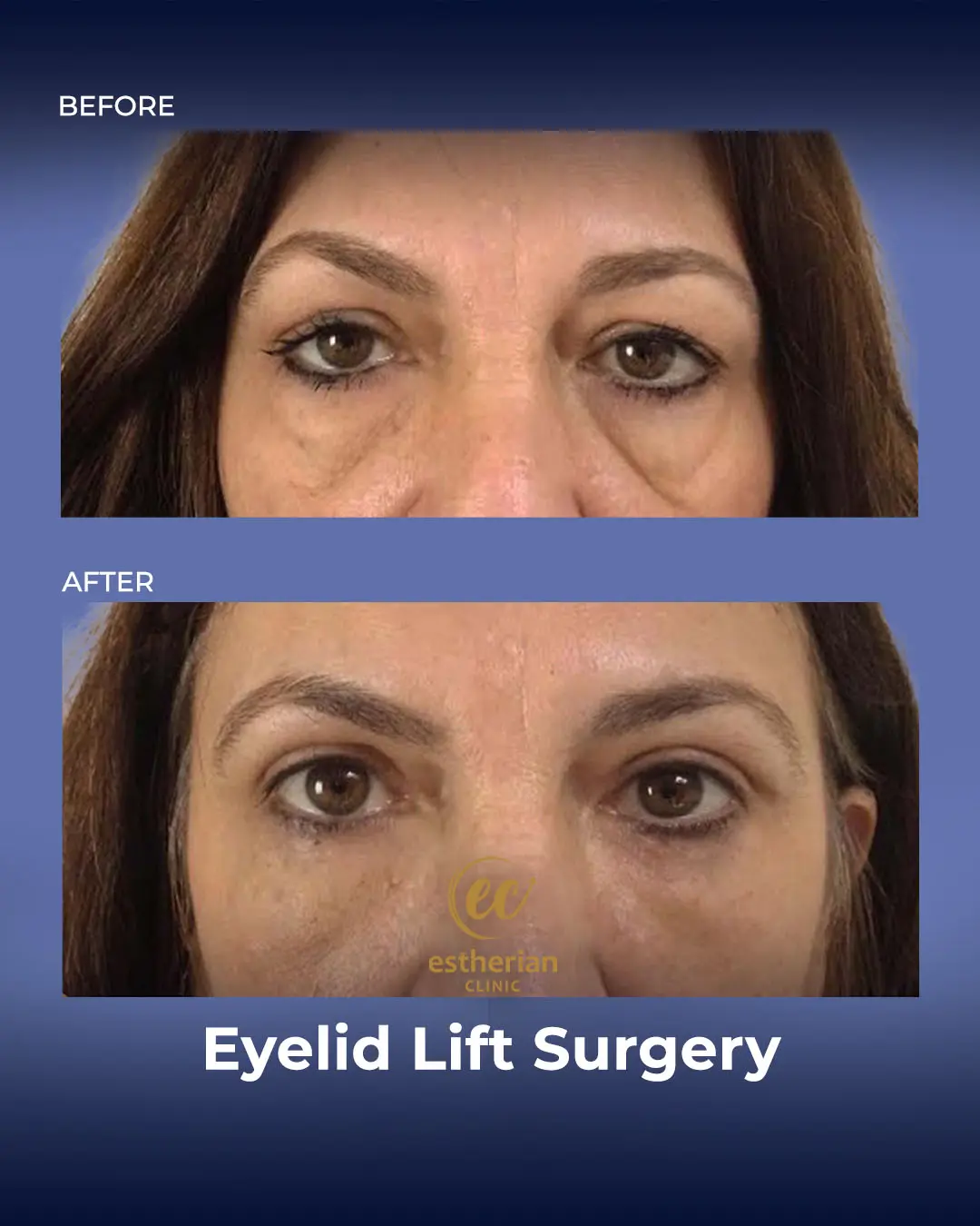 Eyelid Lift Surgery Results by the Estherian Clinic