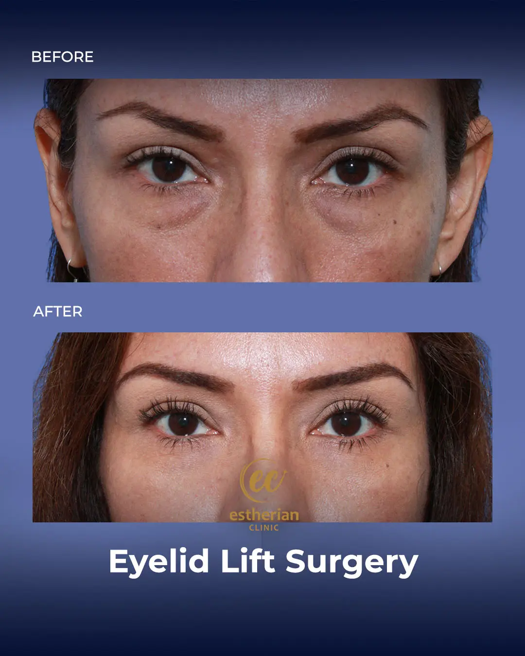 Eyelid Lift Surgery Results by the Estherian Clinic