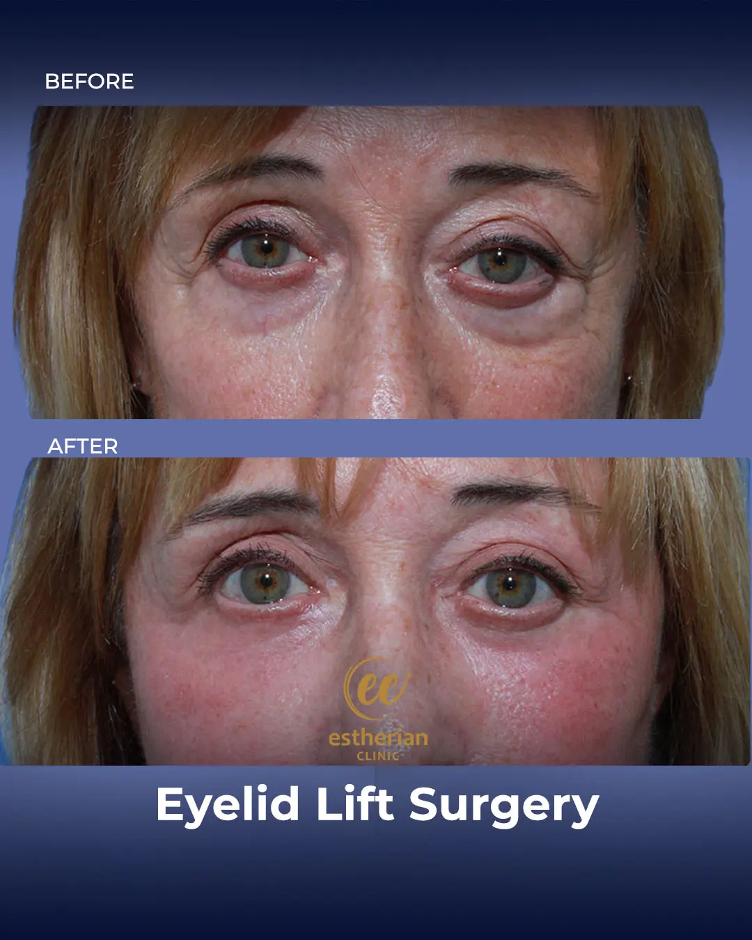 Eyelid Lift Surgery Results by the Estherian Clinic