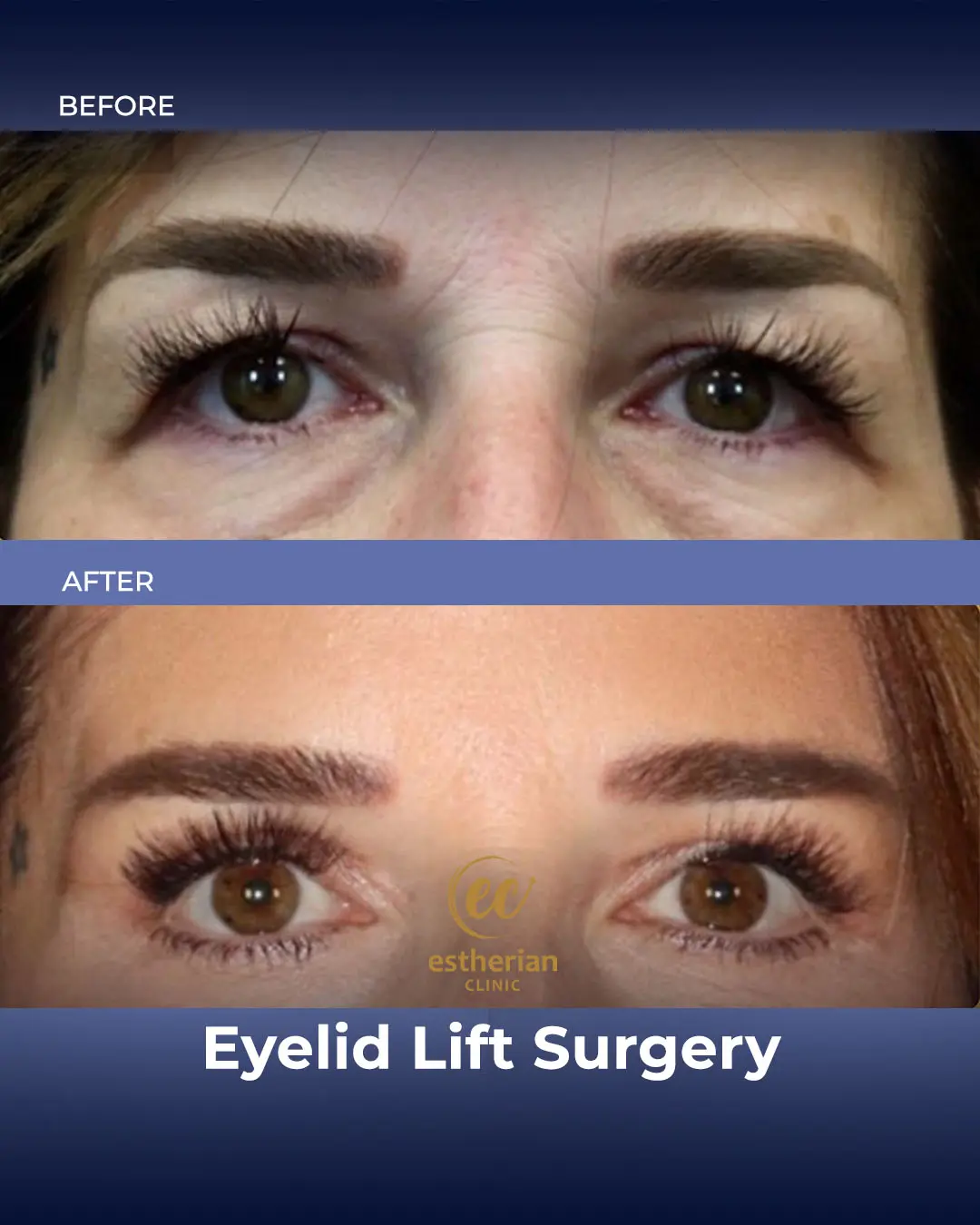 Eyelid Lift Surgery Results by the Estherian Clinic