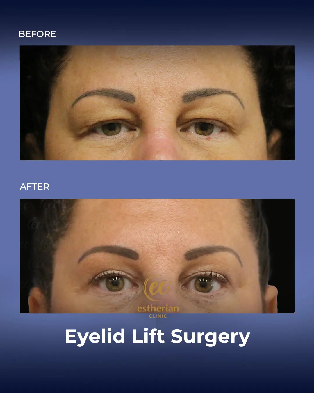 Eyelid Lift Surgery Results by the Estherian Clinic