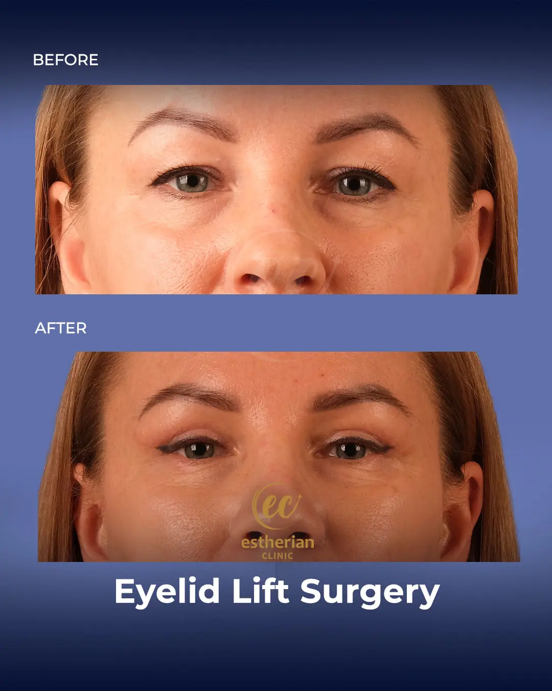 Eyelid Lift Surgery Results by the Estherian Clinic