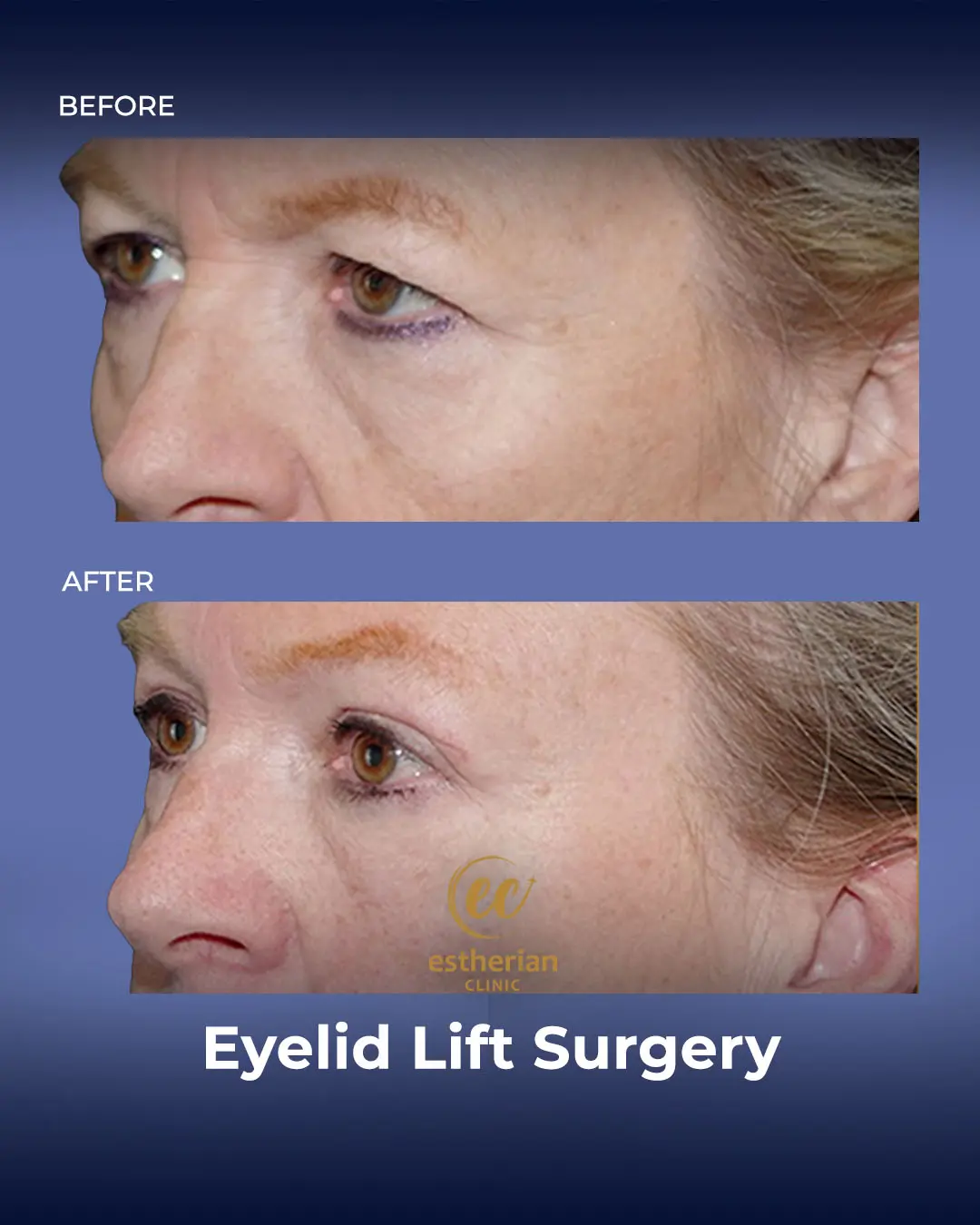 Eyelid Lift Surgery Results by the Estherian Clinic
