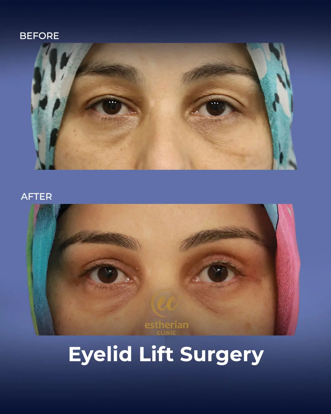 Eyelid Lift Surgery Results by the Estherian Clinic