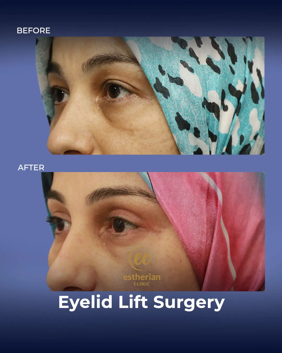 Eyelid Lift Surgery Results by the Estherian Clinic