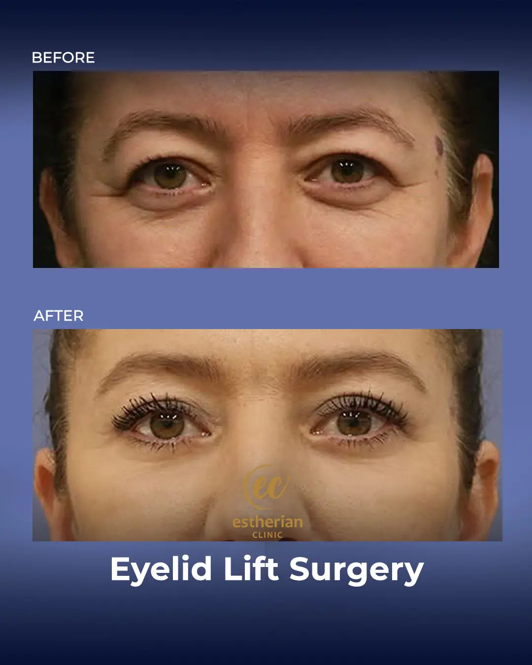 Eyelid Lift Surgery Results by the Estherian Clinic