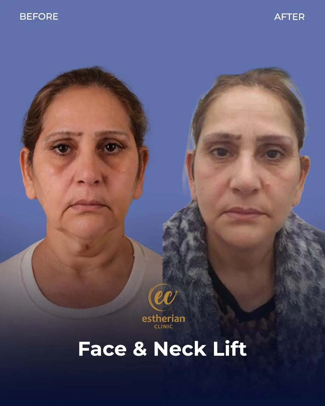 Face and Neck Lift Before and After Gallery by the Estherian Clinic