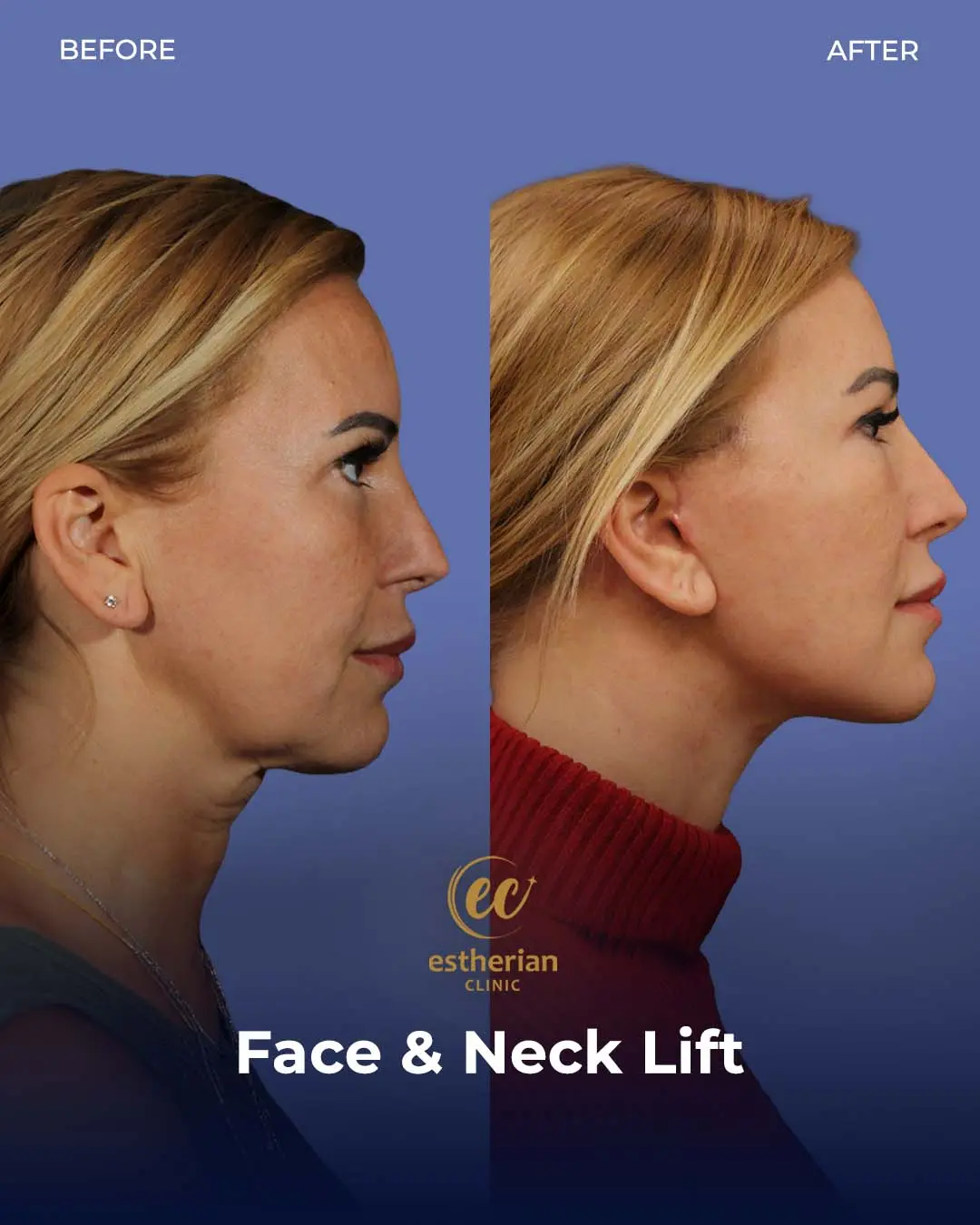 Face and Neck Lift Before and After Gallery by the Estherian Clinic