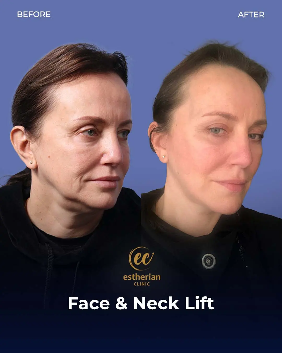 Face and Neck Lift Before and After Gallery by the Estherian Clinic