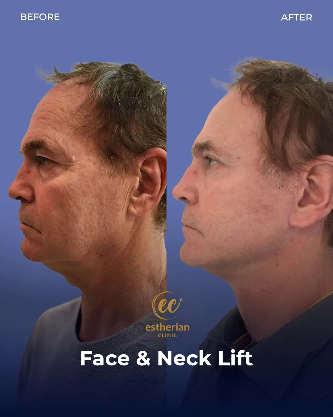Face and Neck Lift Before and After Gallery by the Estherian Clinic