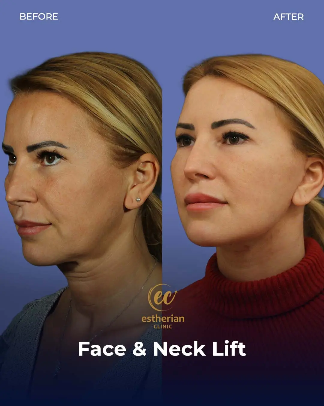 Face and Neck Lift Before and After Gallery by the Estherian Clinic