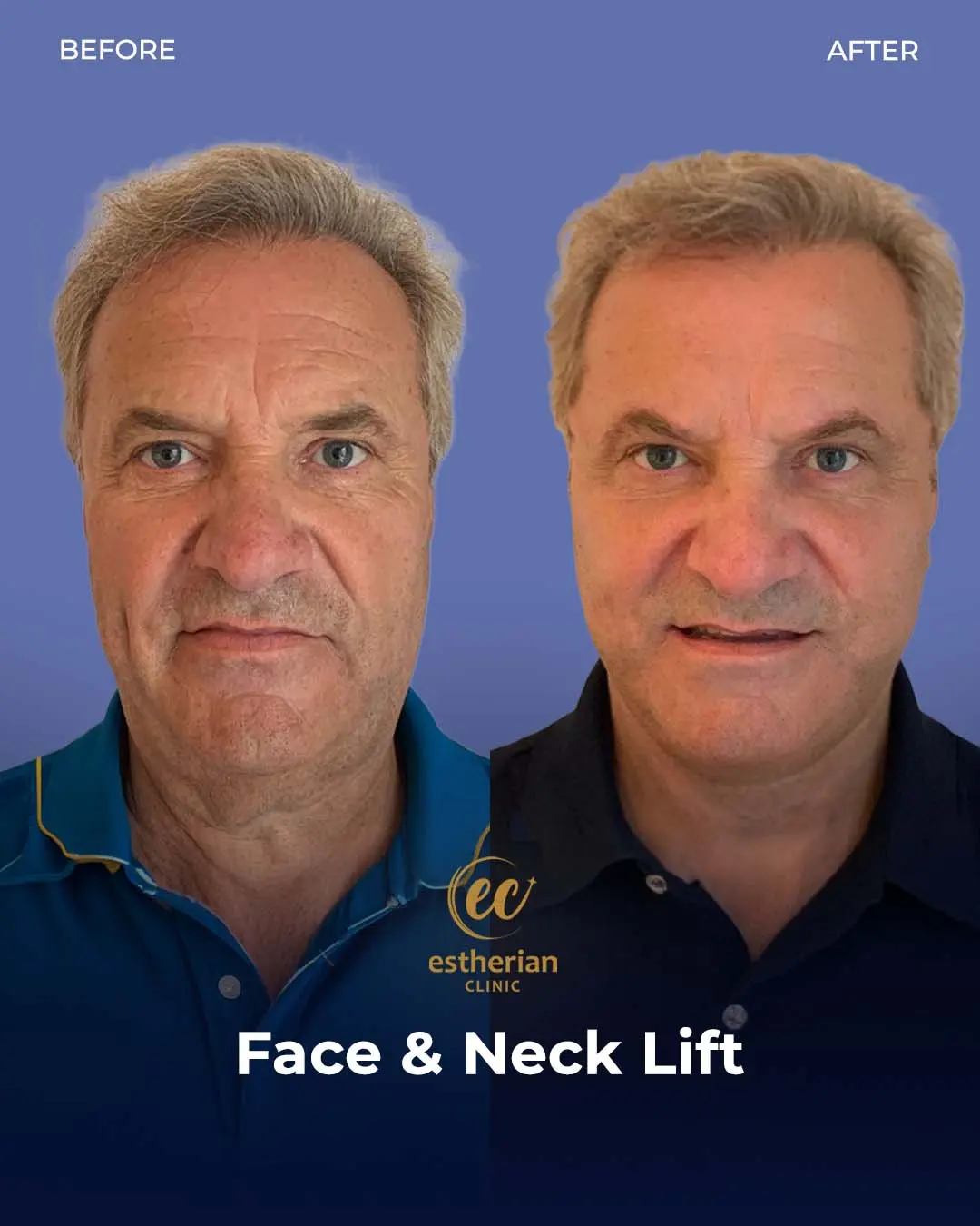 Face and Neck Lift Before and After Gallery by the Estherian Clinic