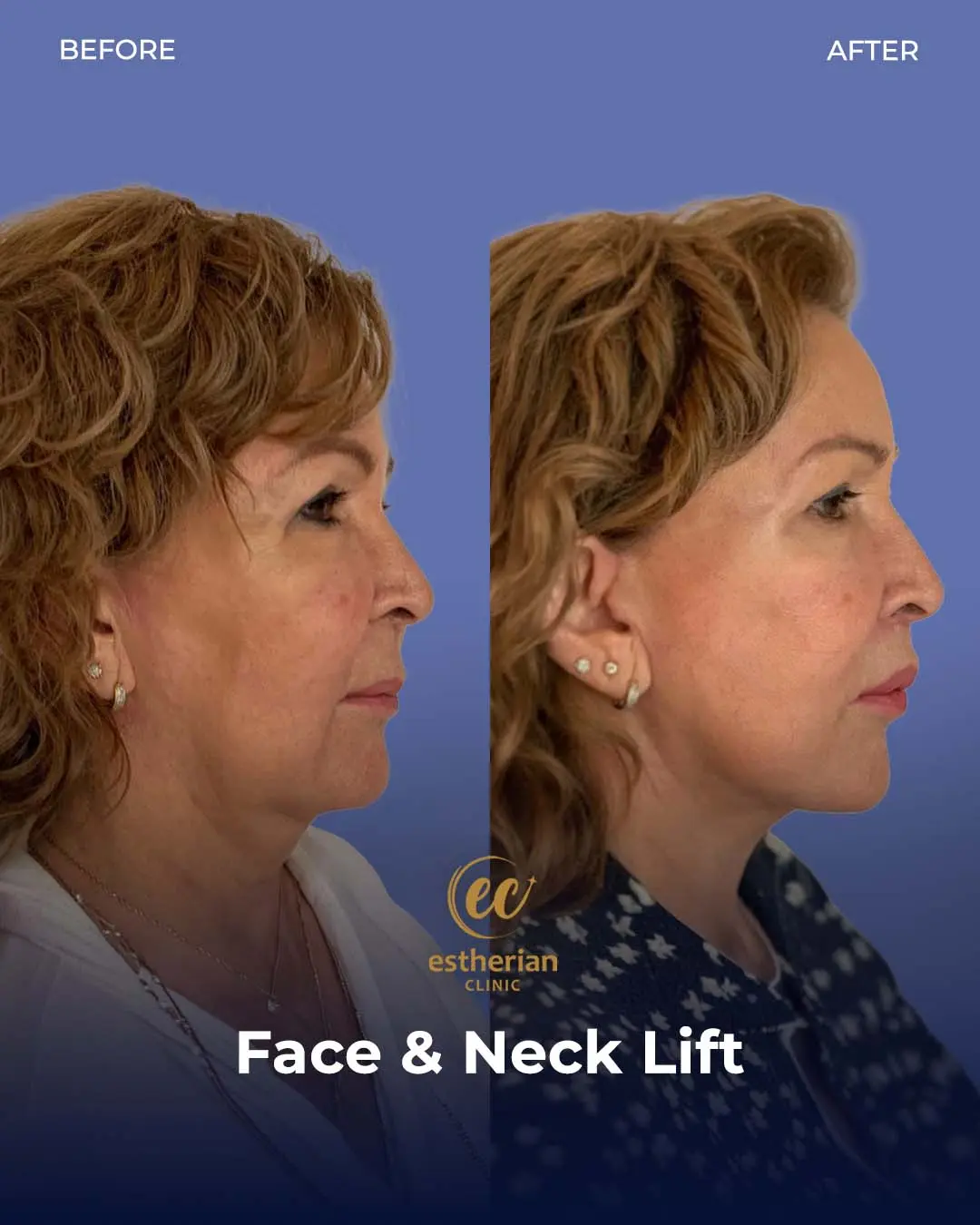 Face and Neck Lift Before and After Gallery by the Estherian Clinic
