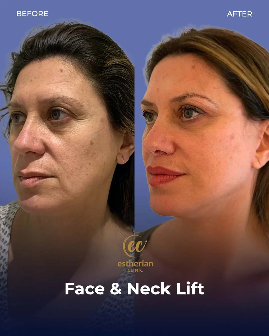 Face and Neck Lift Before and After Gallery by the Estherian Clinic