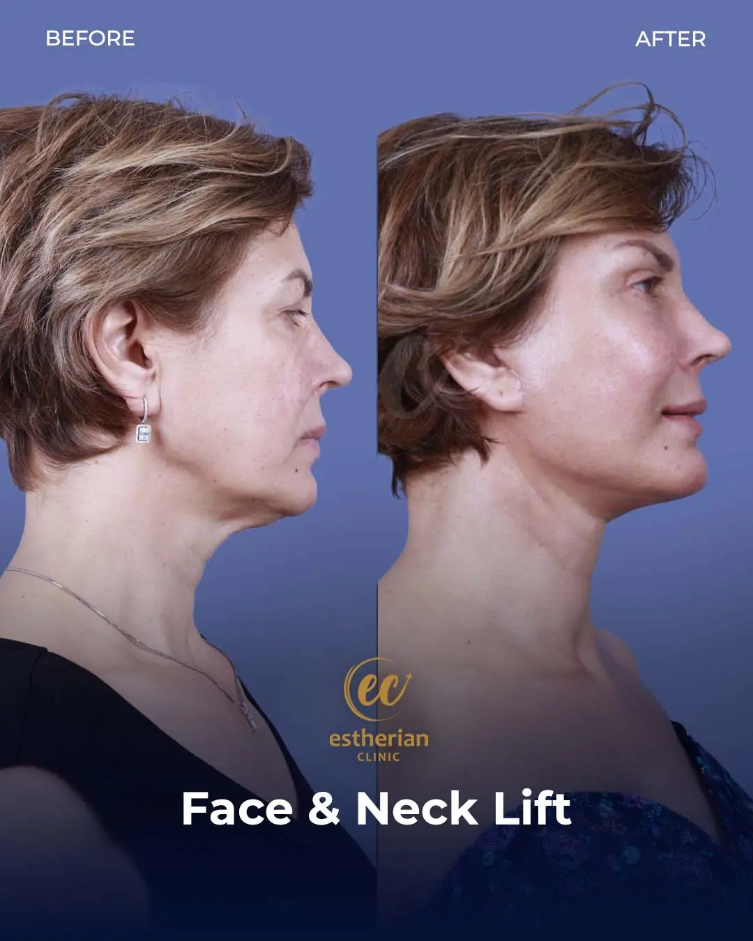Face and Neck Lift Before and After Gallery by the Estherian Clinic