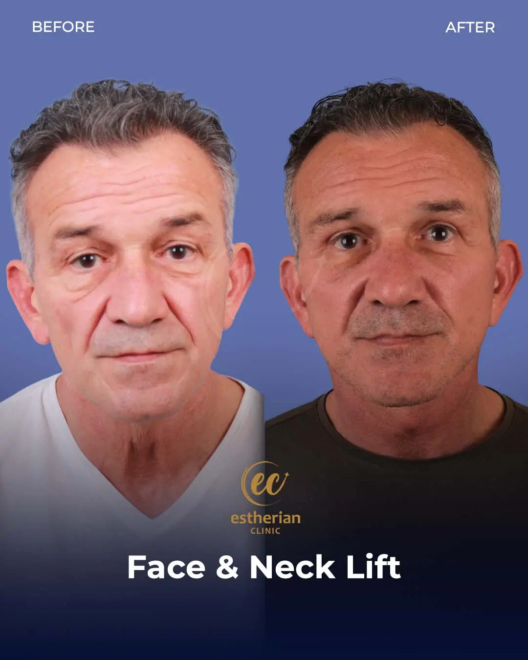 Face and Neck Lift Before and After Gallery by the Estherian Clinic