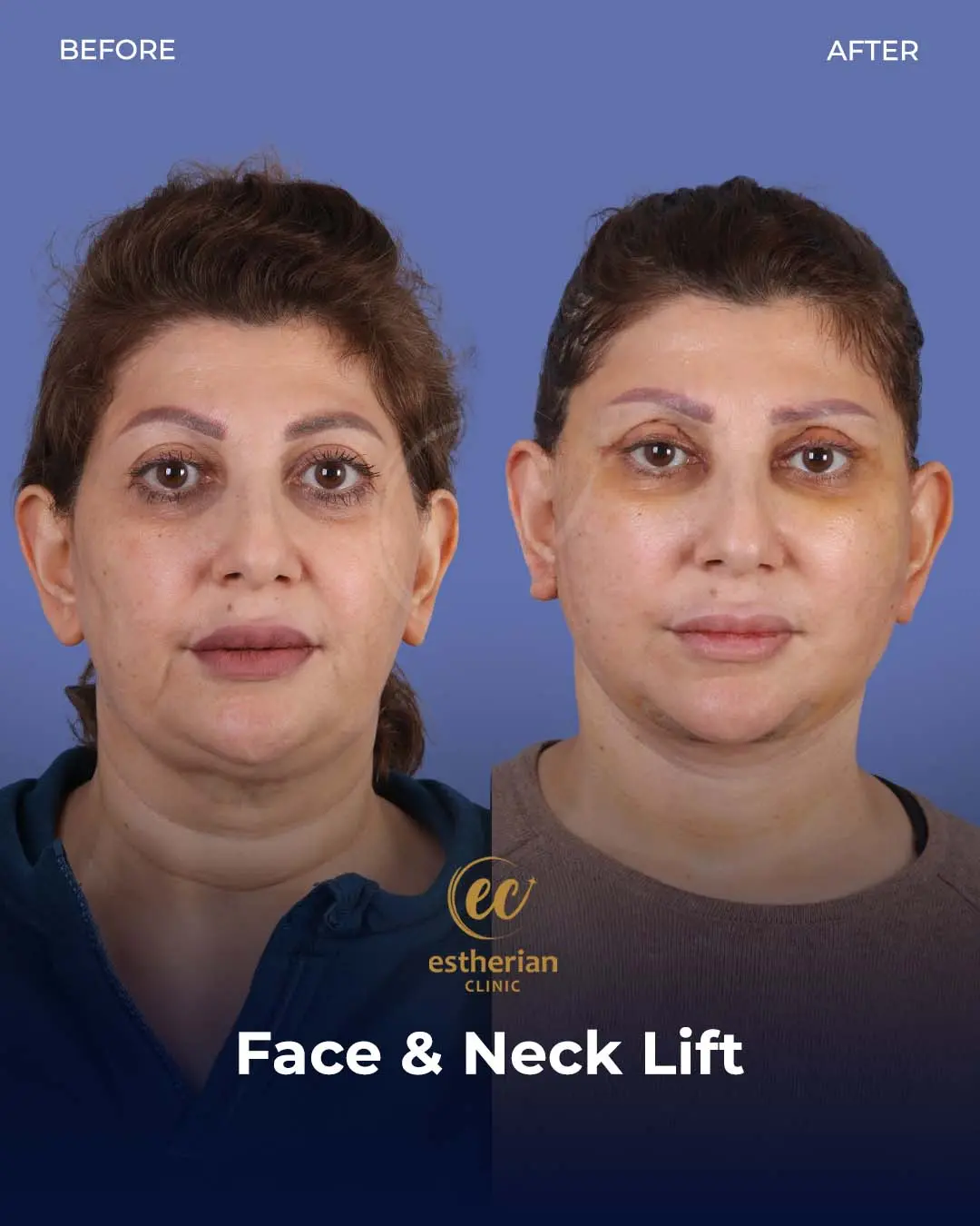 Face and Neck Lift Before and After Gallery by the Estherian Clinic