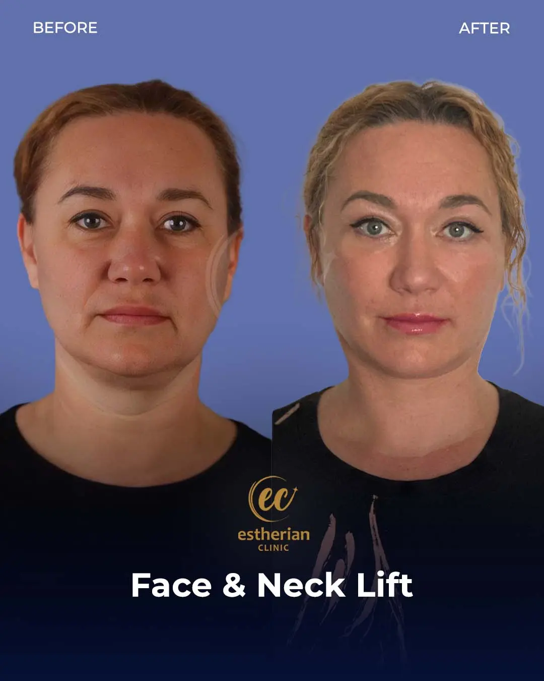 Face and Neck Lift Before and After Gallery by the Estherian Clinic