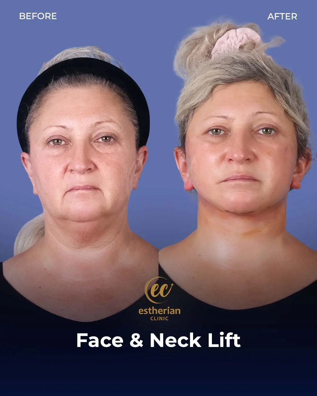 Face and Neck Lift Before and After Gallery by the Estherian Clinic