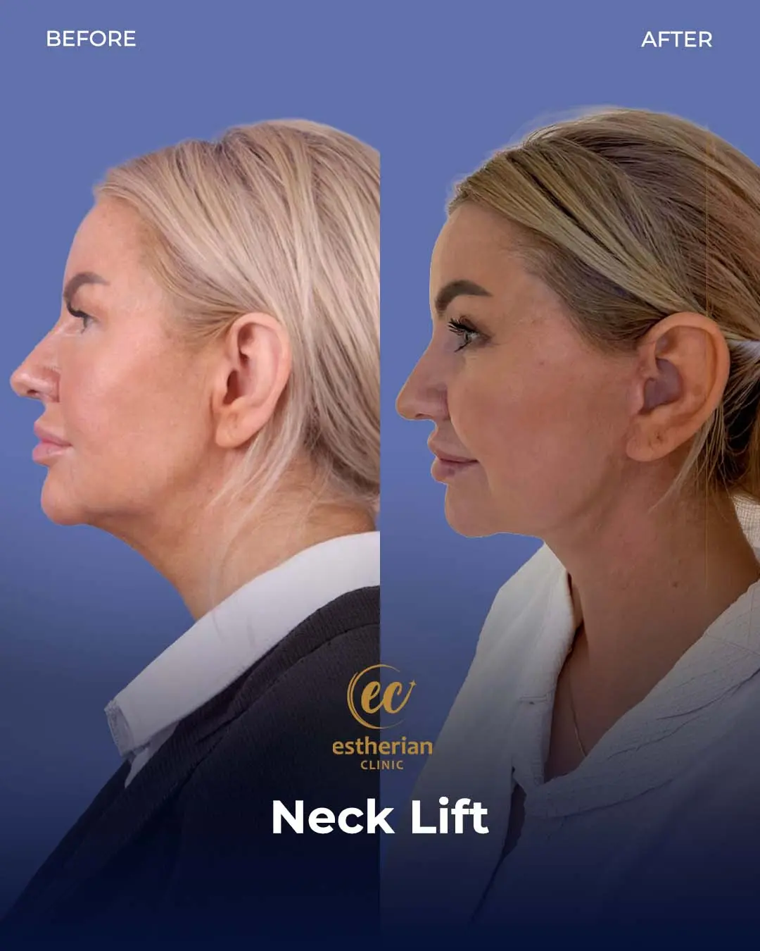 Neck Lift Before and After Gallery by the Estherian Clinic