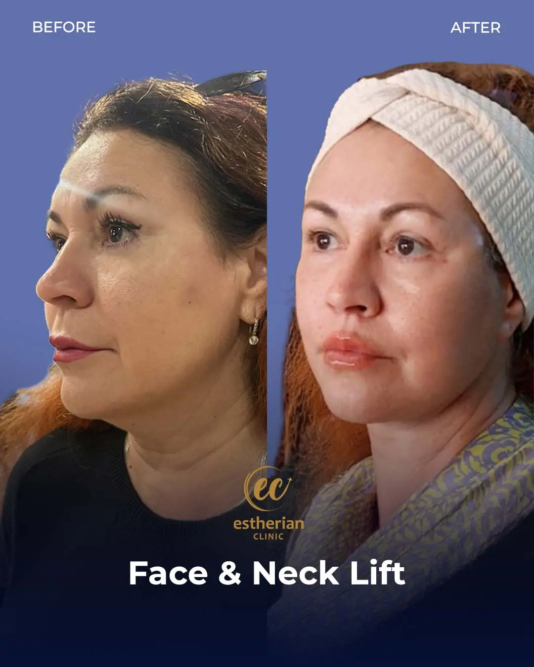 Face and Neck Lift Before and After Gallery by the Estherian Clinic