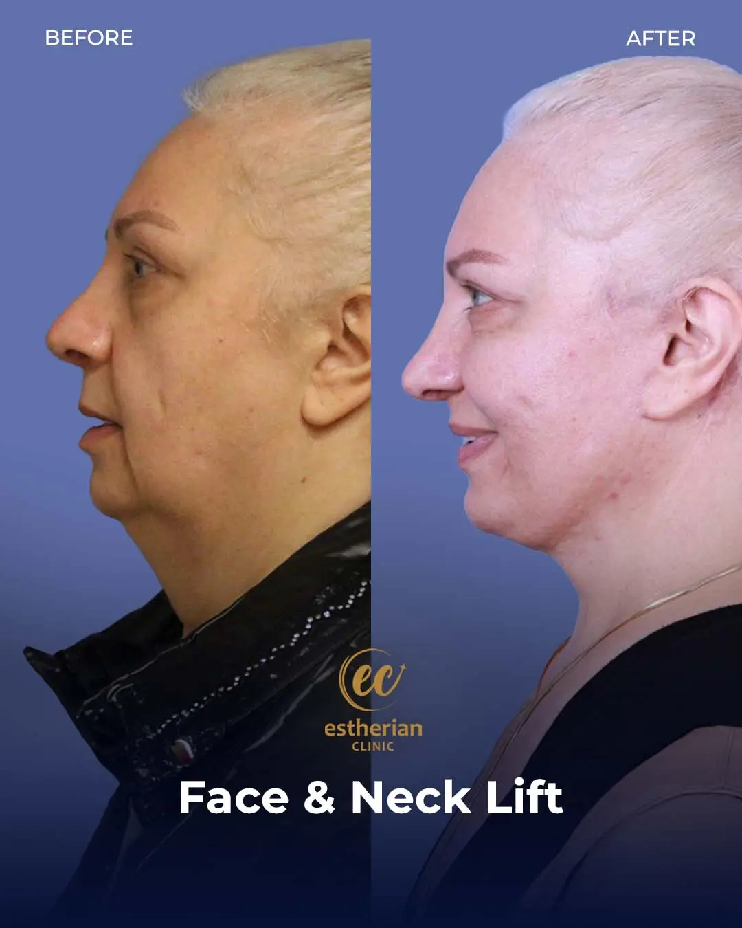 Face and Neck Lift Before and After Gallery by the Estherian Clinic